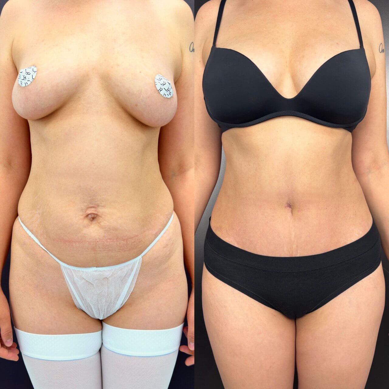 Абдоминопластика с переносом пупка 01