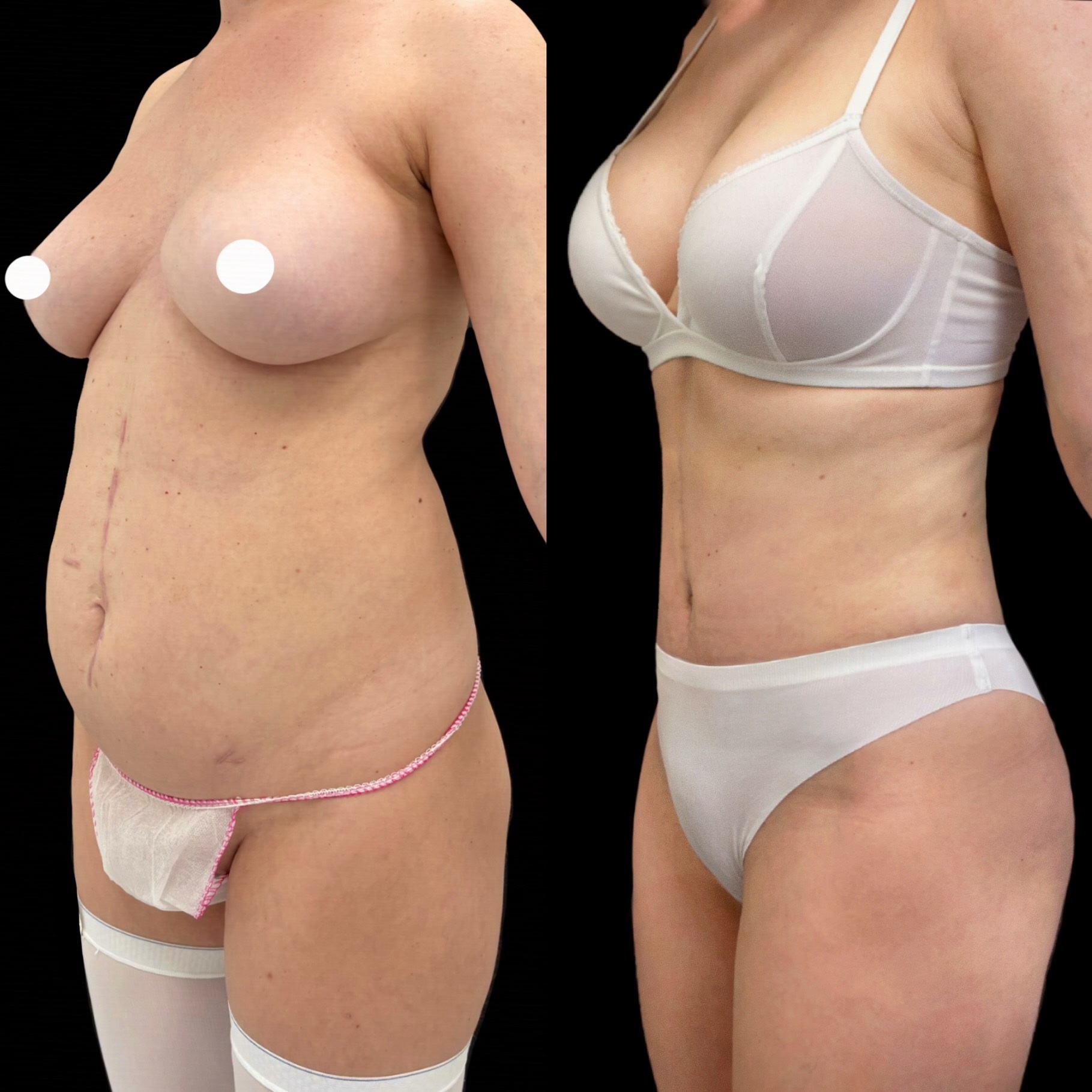 Абдоминопластика с переносом пупка 01