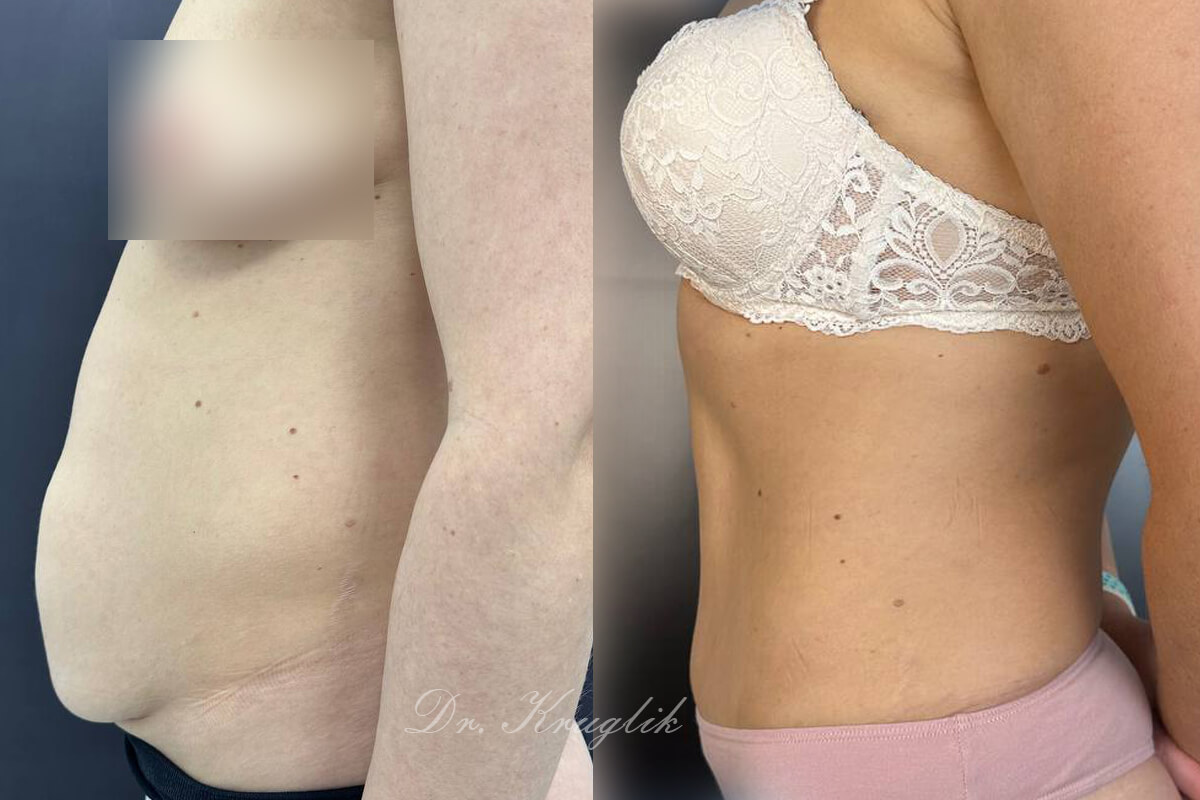 Абдоминопластика с переносом пупка 01