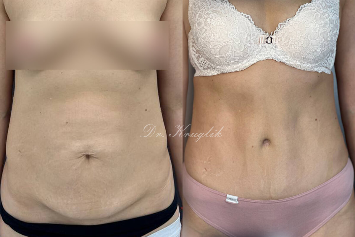 Абдоминопластика с переносом пупка 01