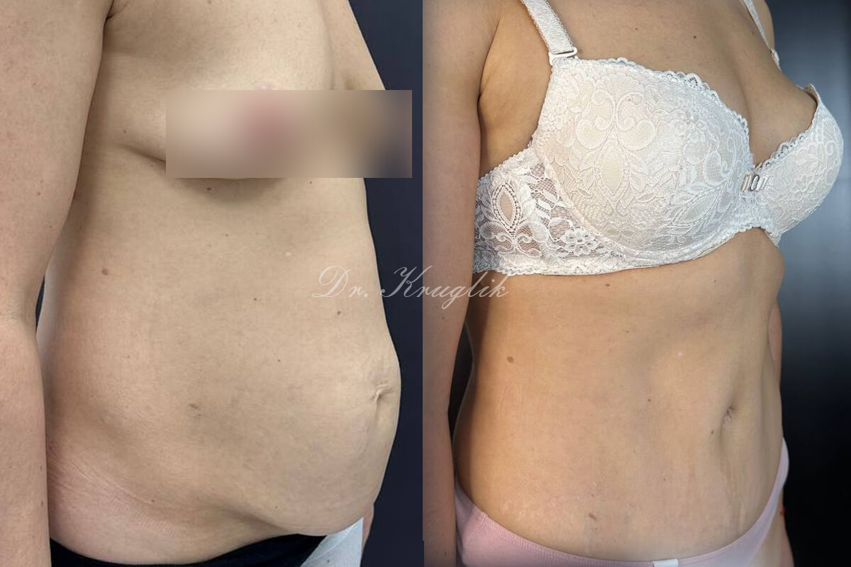 Абдоминопластика с переносом пупка 01