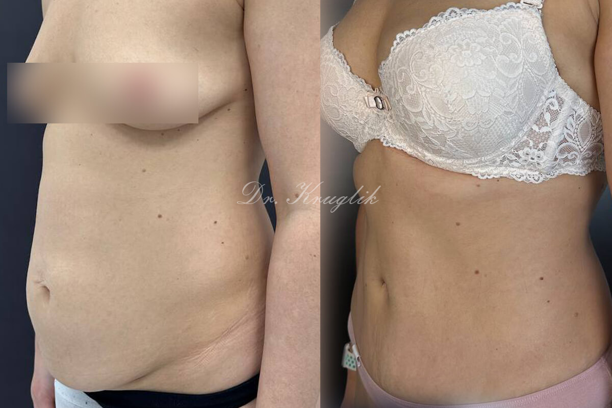 Абдоминопластика с переносом пупка 01