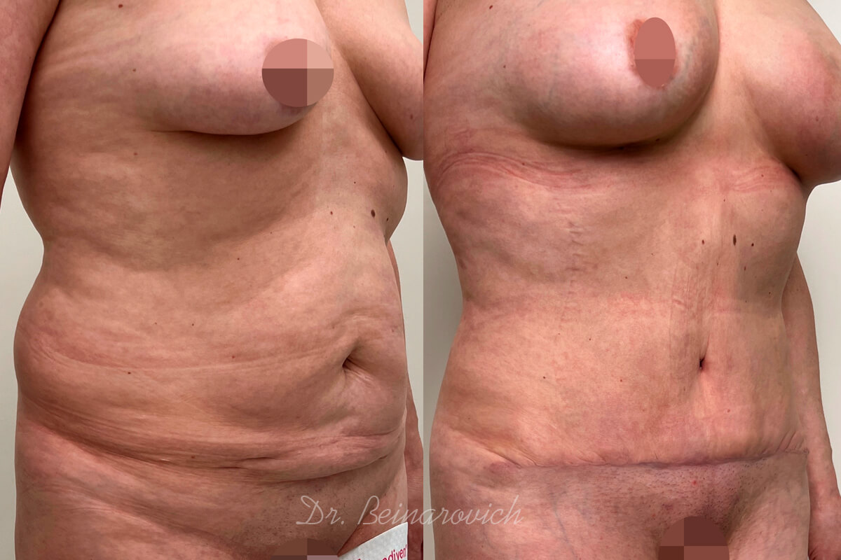 Ушивание диастаза 01