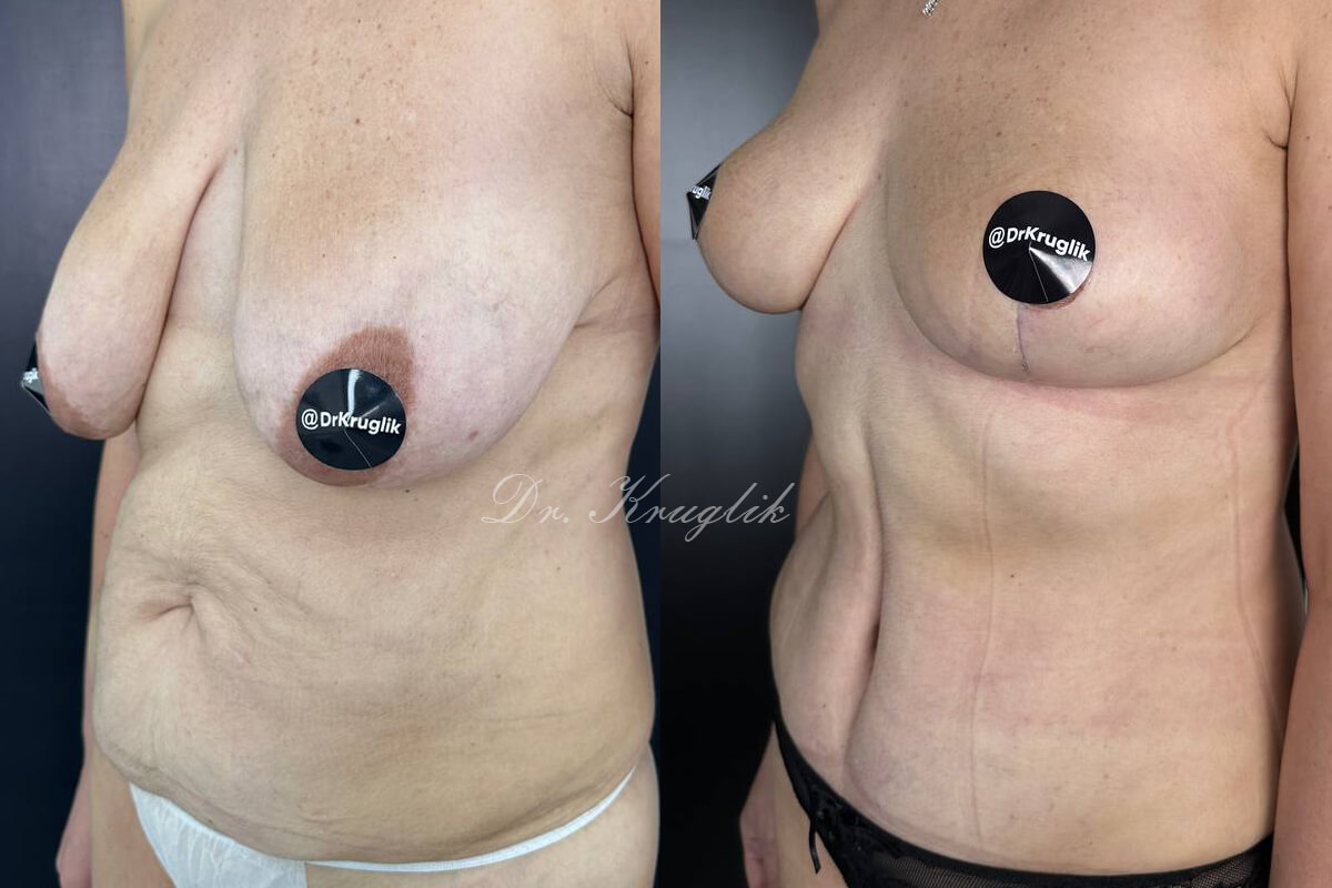 Подтяжка груди (мастопексия) 01