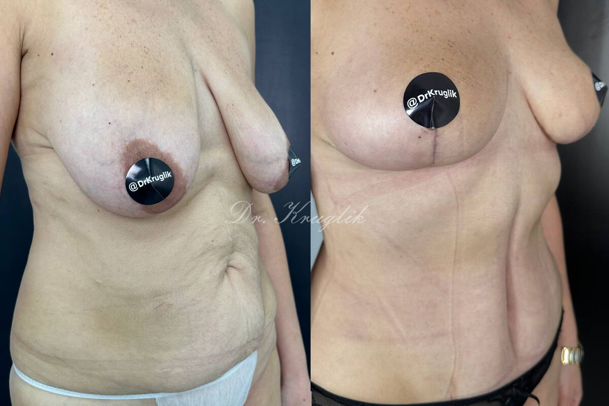 Подтяжка груди (мастопексия) 01