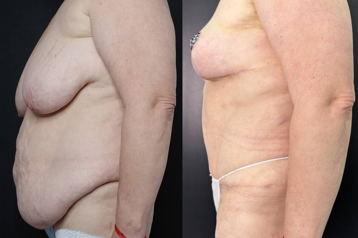 Уменьшение груди (редукция) 01