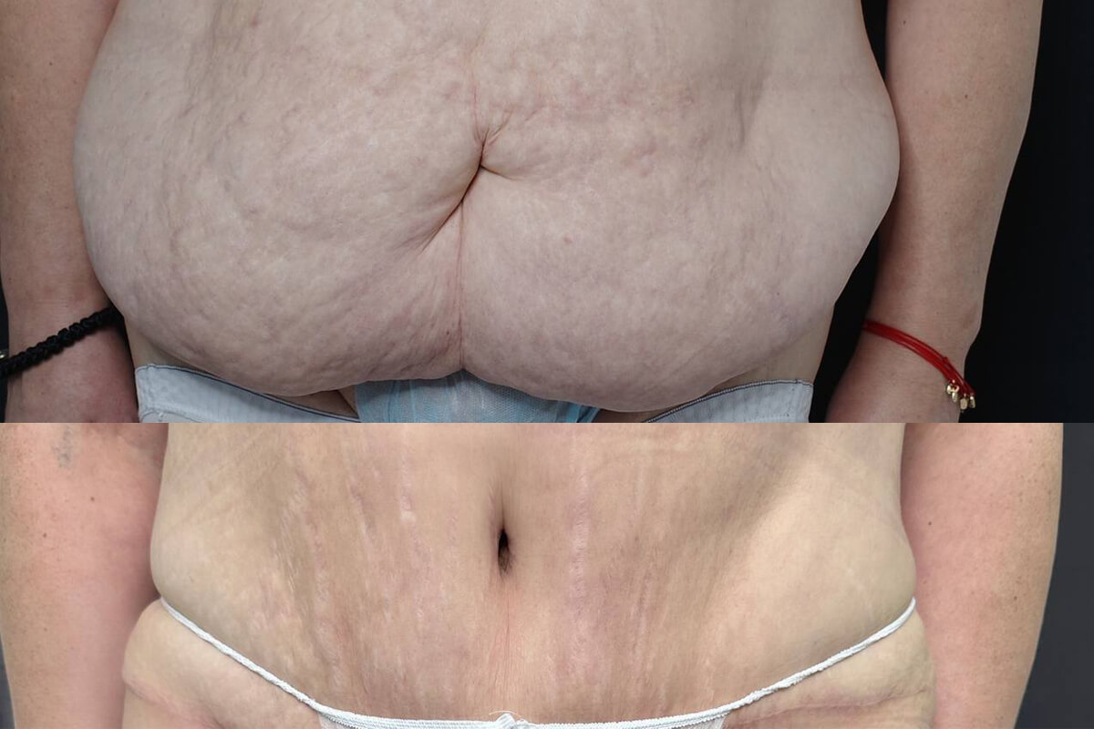 Абдоминопластика с переносом пупка 01