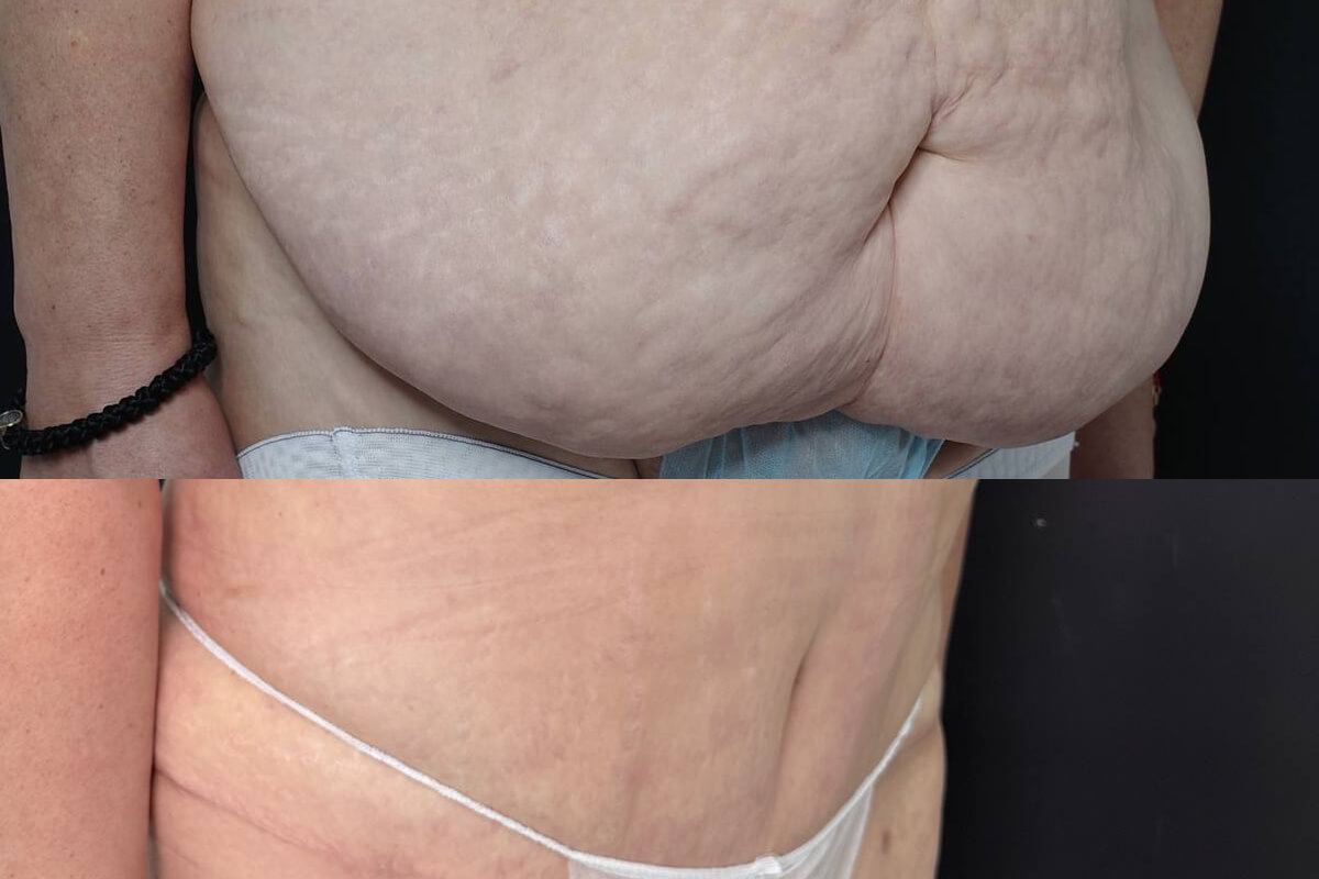 Абдоминопластика с переносом пупка 01
