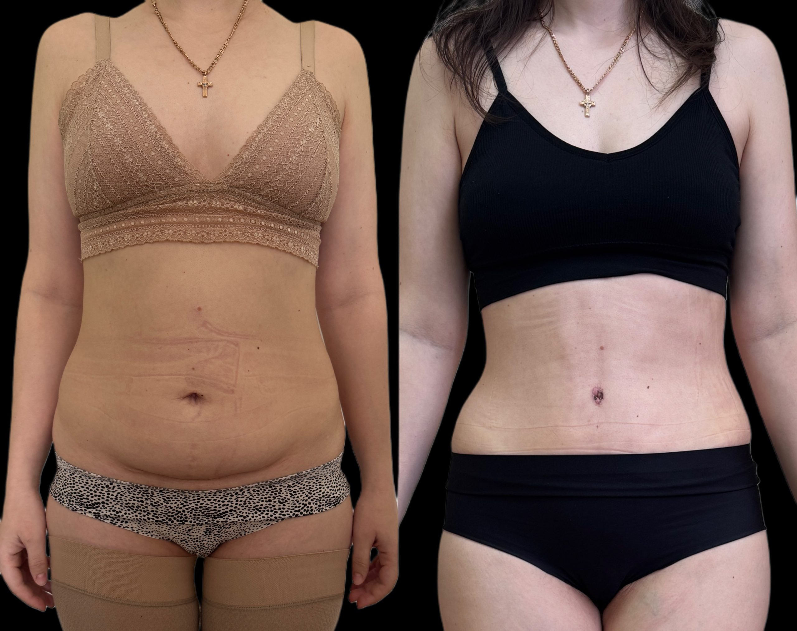 Миниабдоминопластика 01