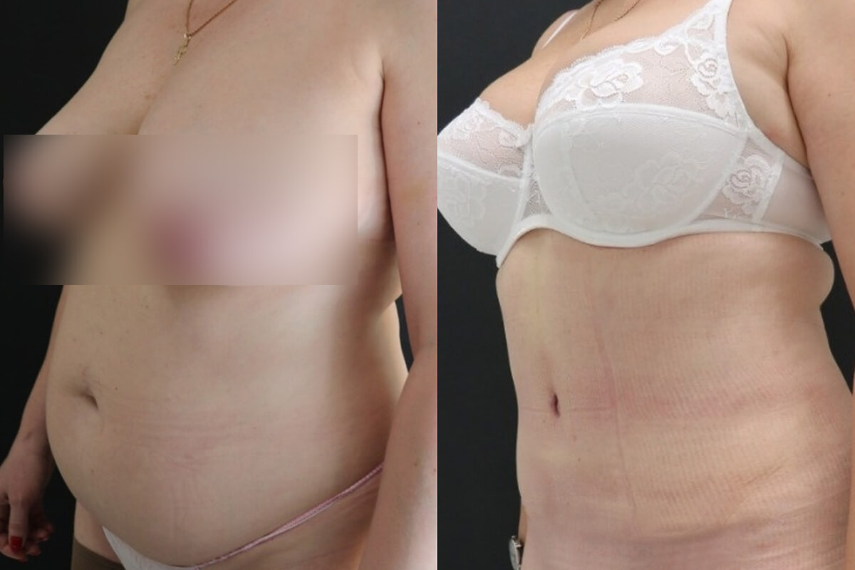 Абдоминопластика с переносом пупка 01