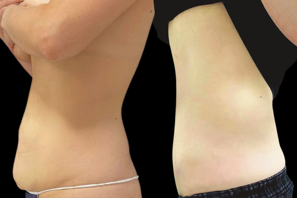 Абдоминопластика с переносом пупка 01