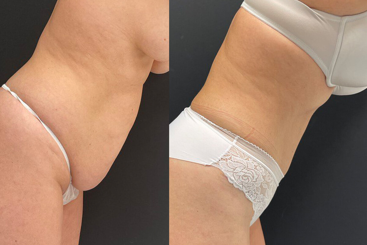 Ушивание диастаза 01