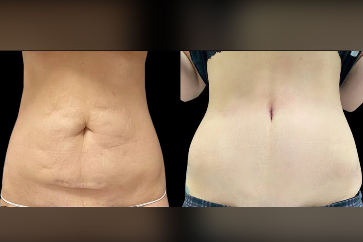 Абдоминопластика с переносом пупка 01