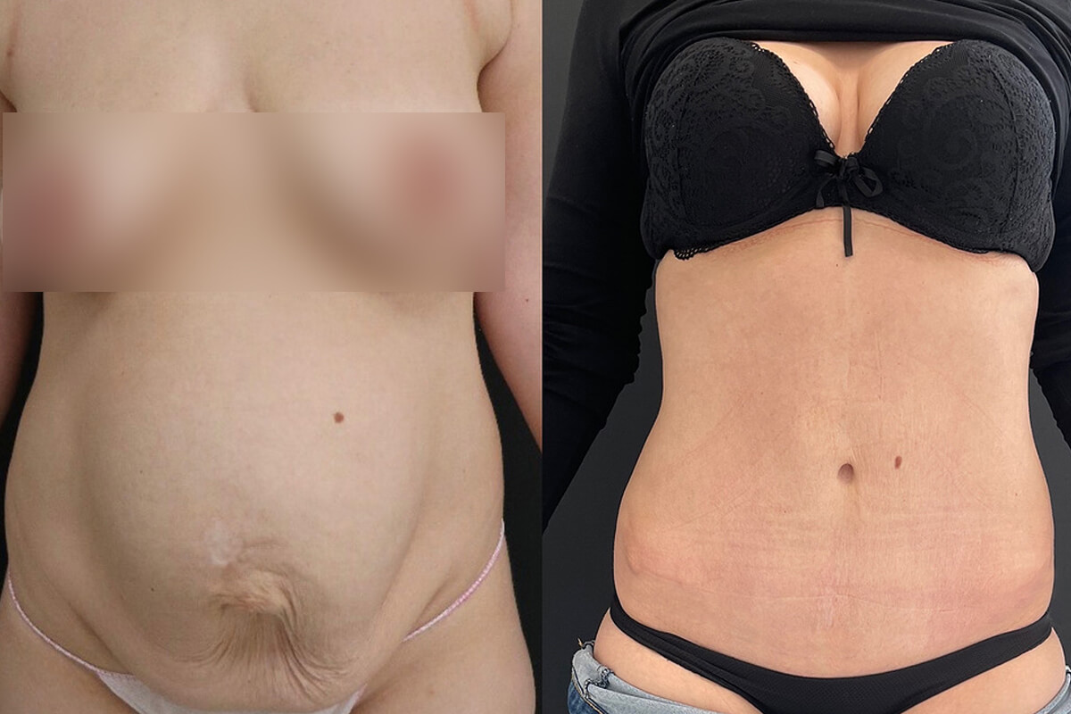 Абдоминопластика с переносом пупка 01