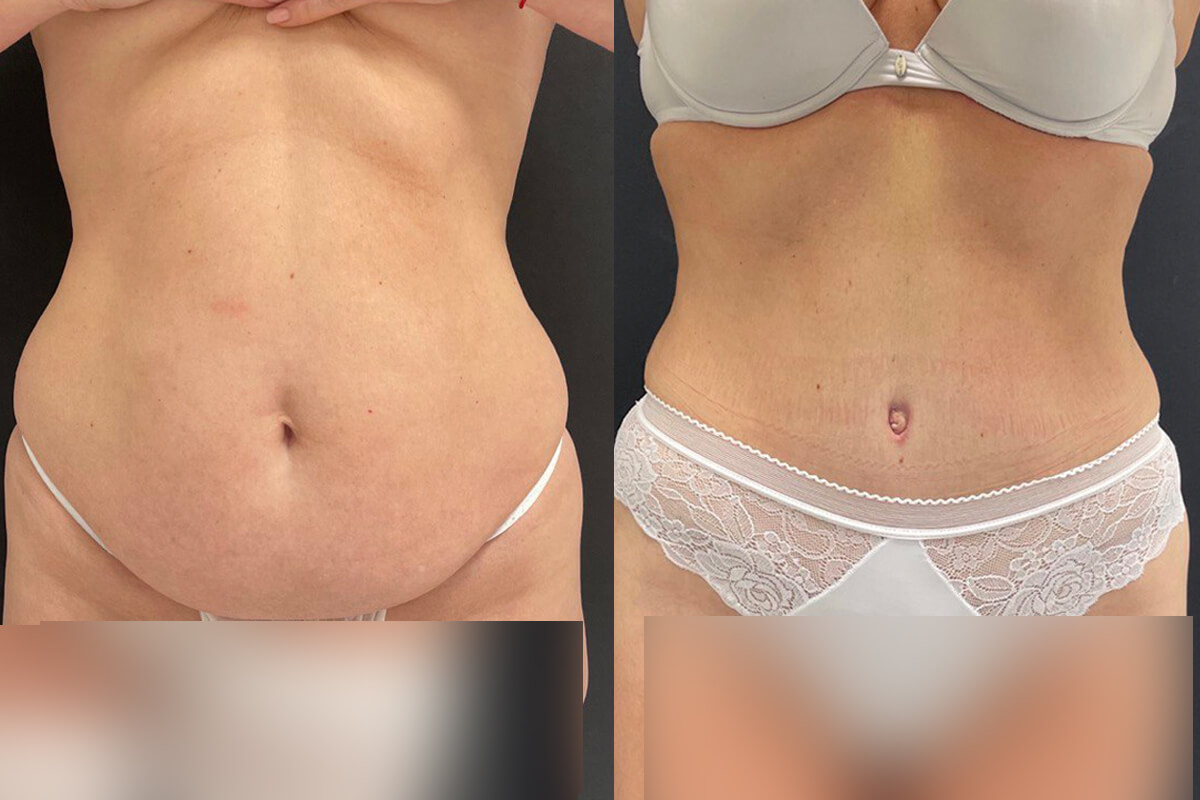 Ушивание диастаза 01