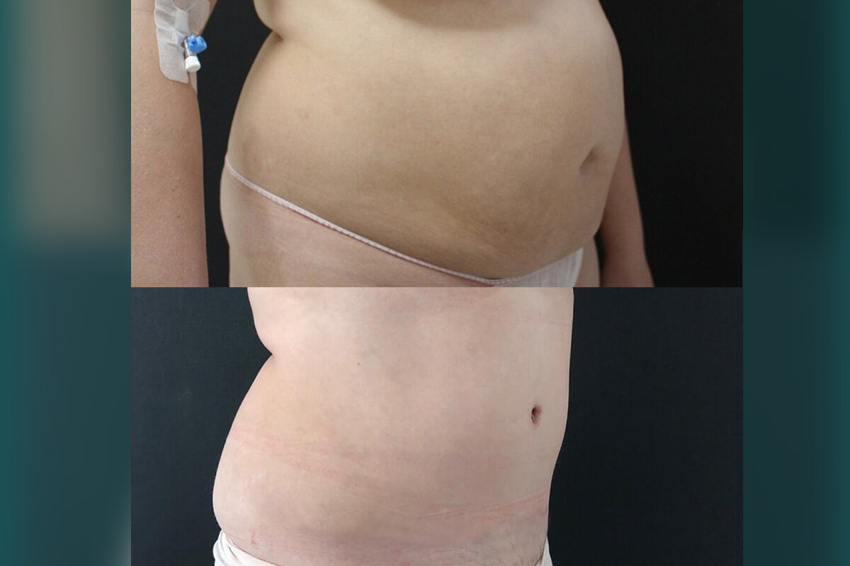 Абдоминопластика с переносом пупка 01