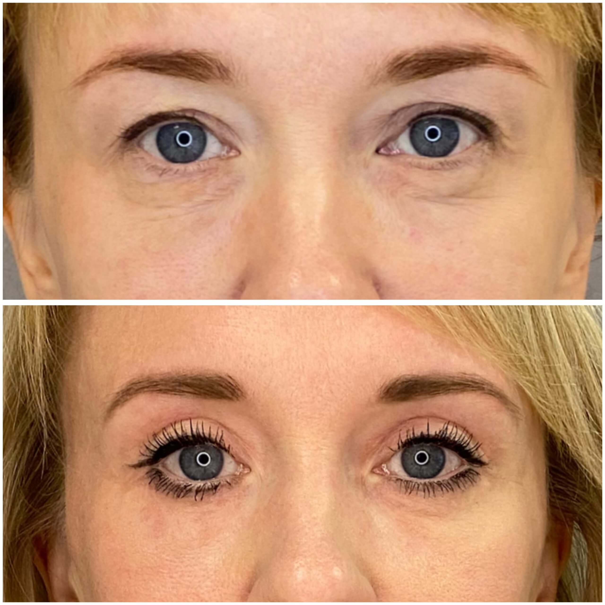 Нижняя блефаропластика 01