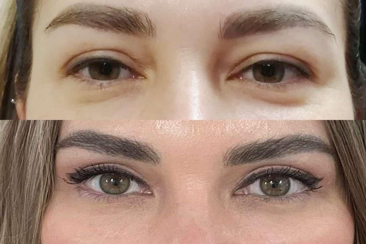 Нижняя блефаропластика 01