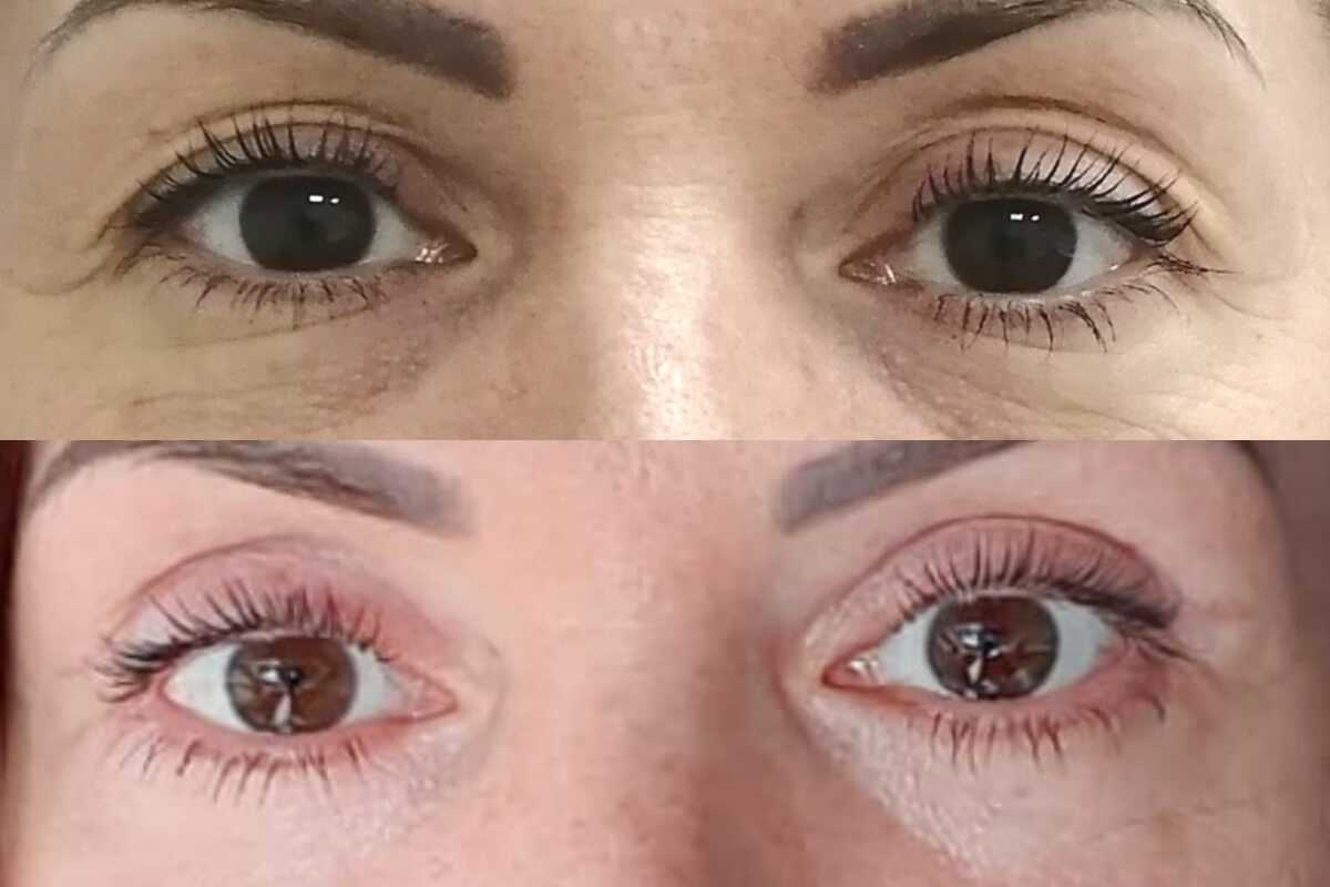 Нижняя блефаропластика 01