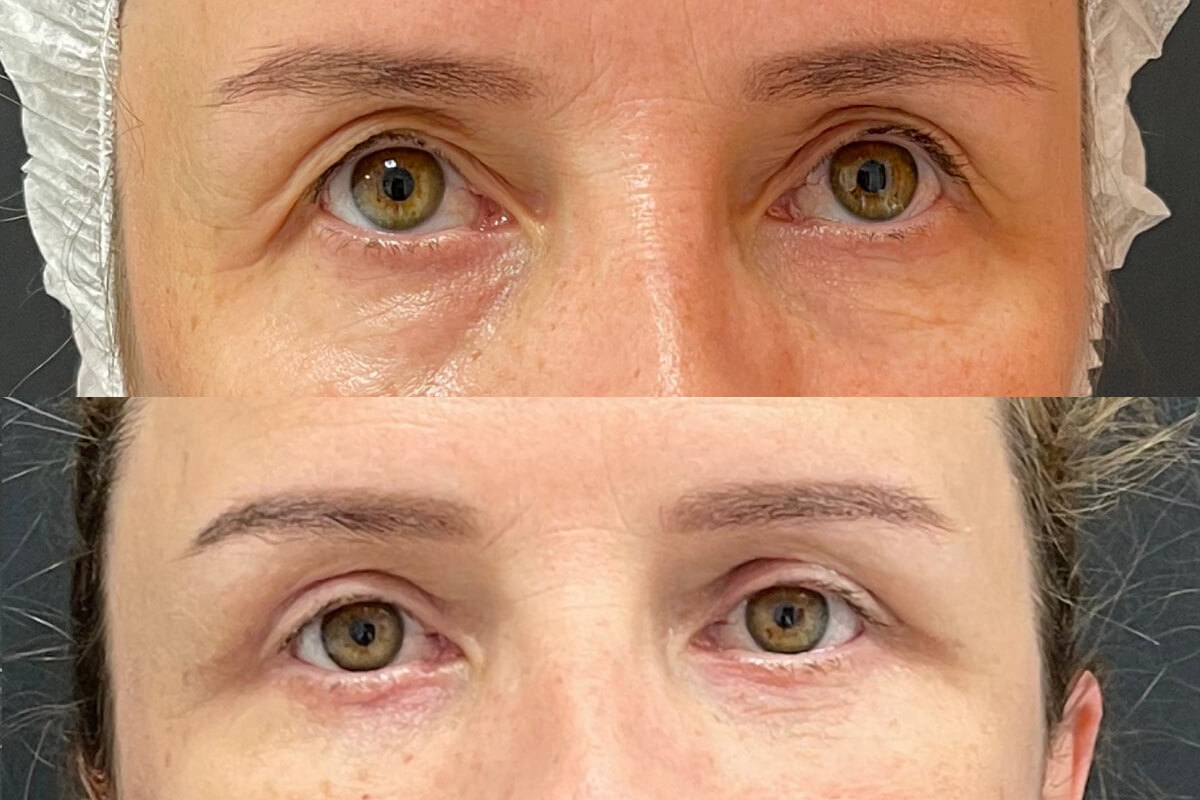 Нижняя блефаропластика 01