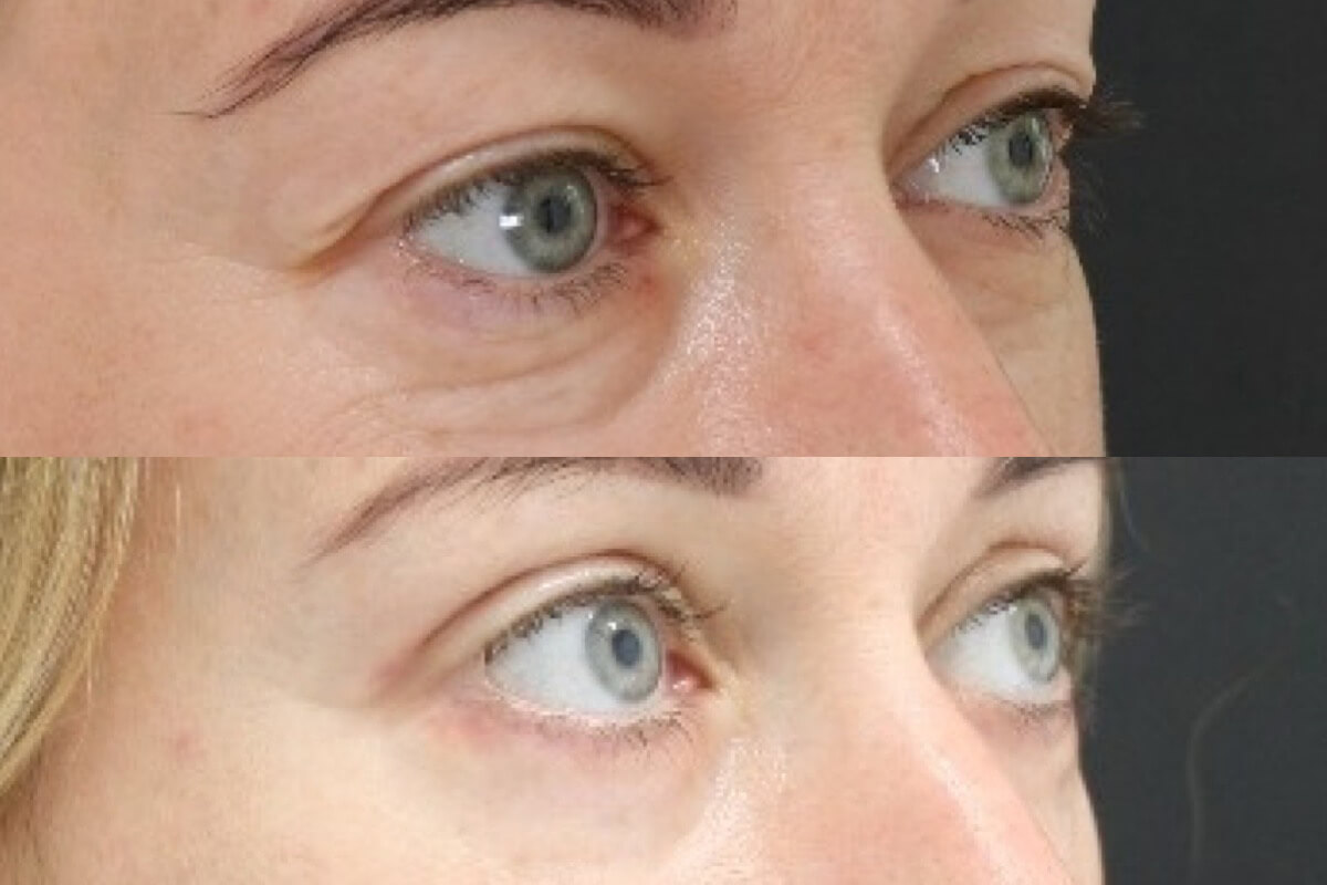 Нижняя блефаропластика 01