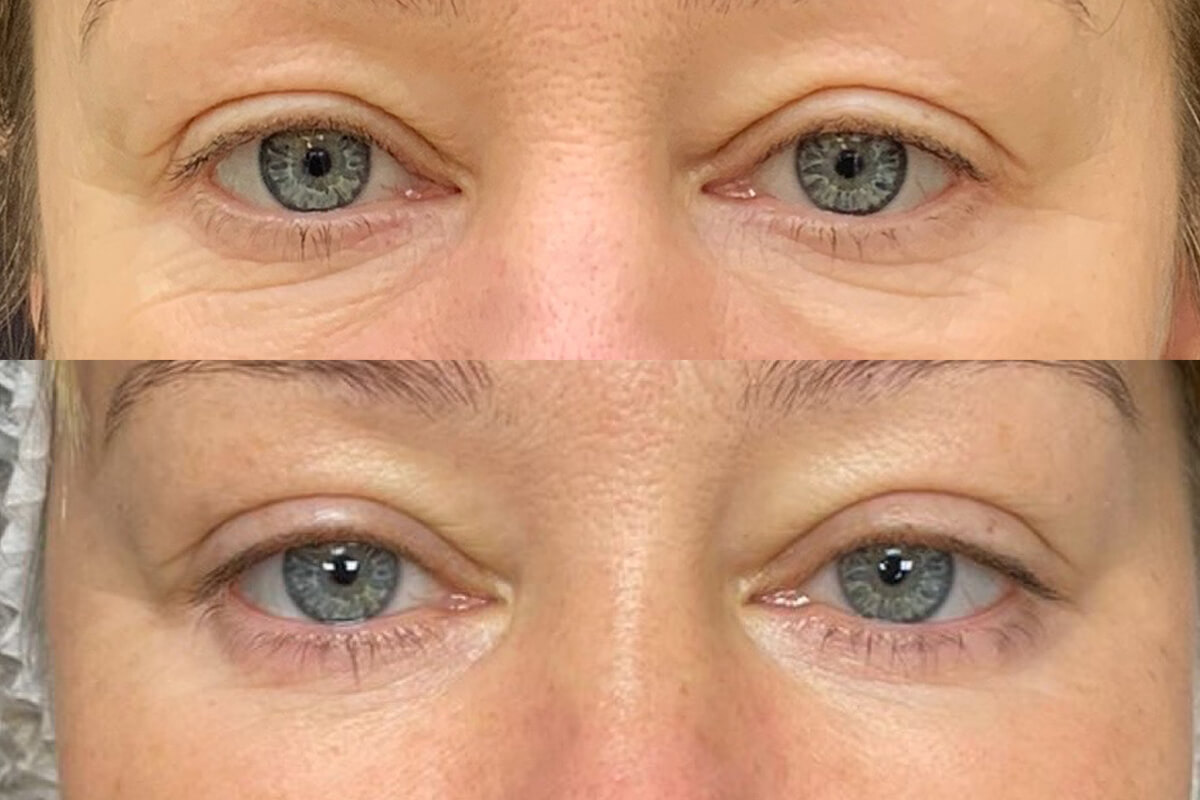 Нижняя блефаропластика 01