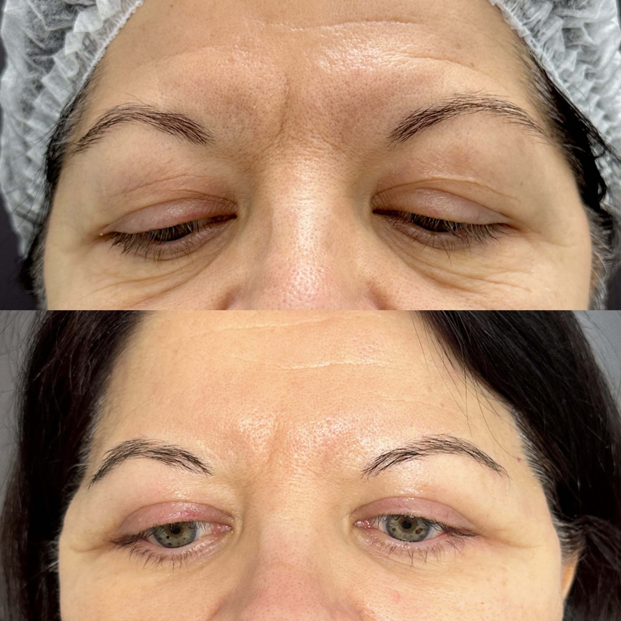 Нижняя блефаропластика 01