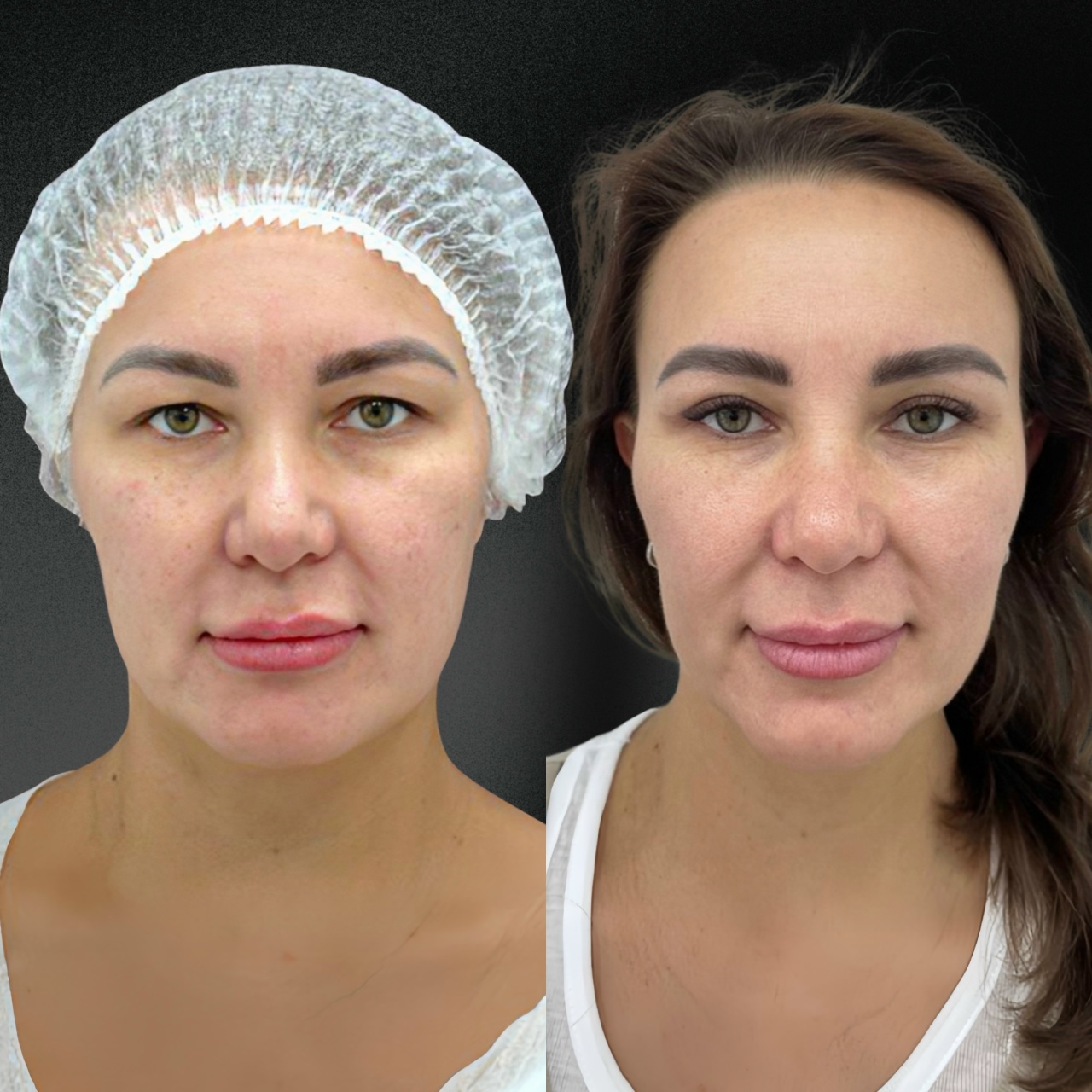 Нижняя блефаропластика 01