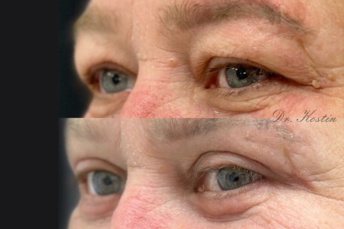 Нижняя блефаропластика 01