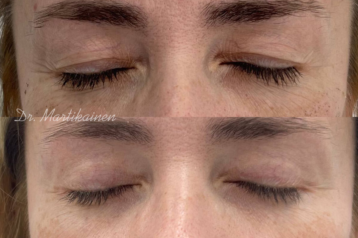 Нижняя блефаропластика 01