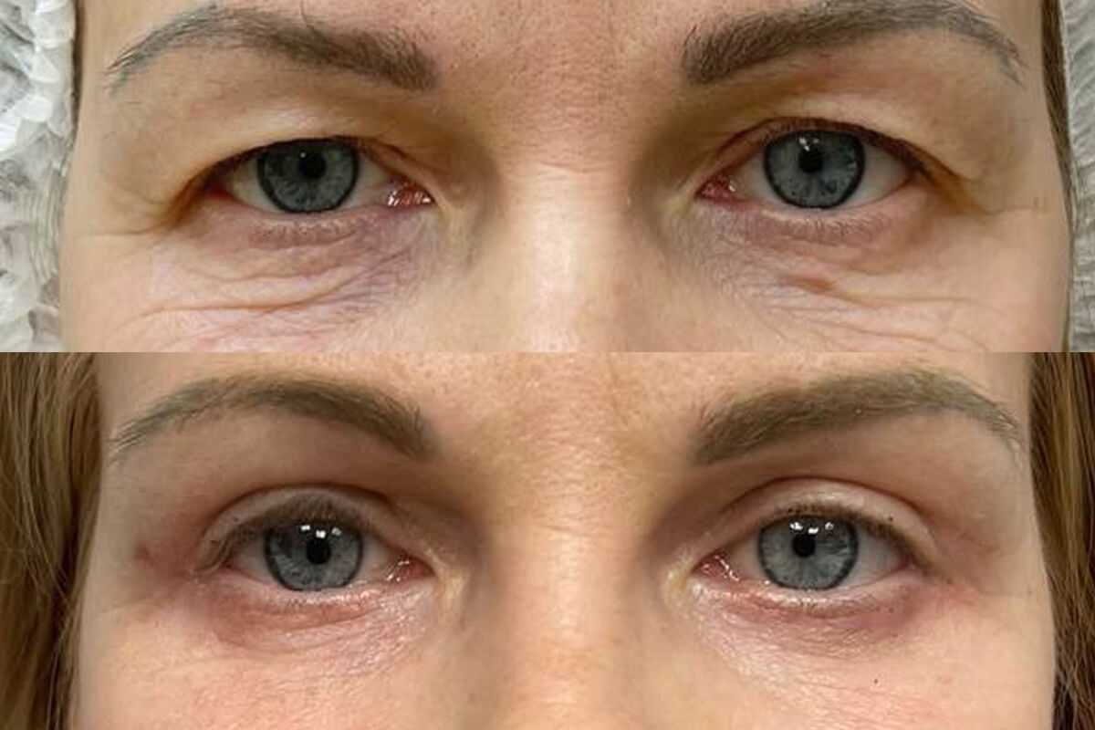 Нижняя блефаропластика 01