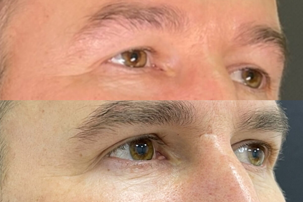 Нижняя блефаропластика 01