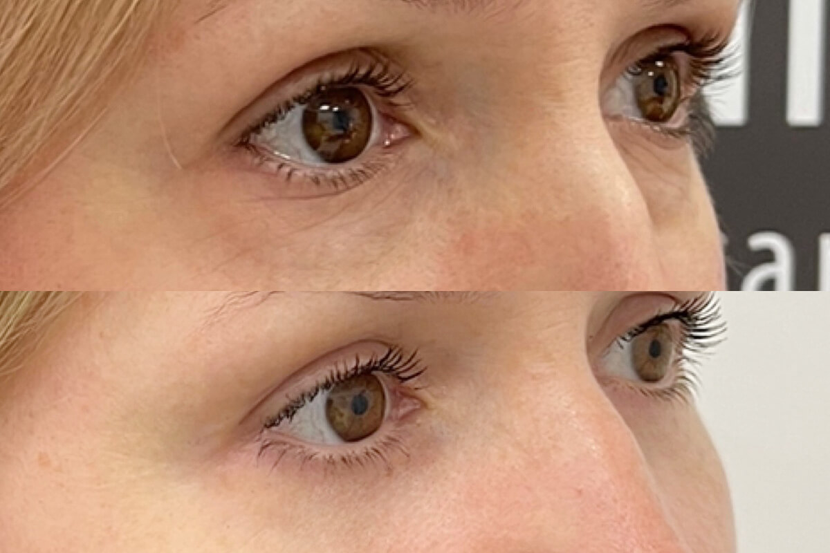 Нижняя блефаропластика 01