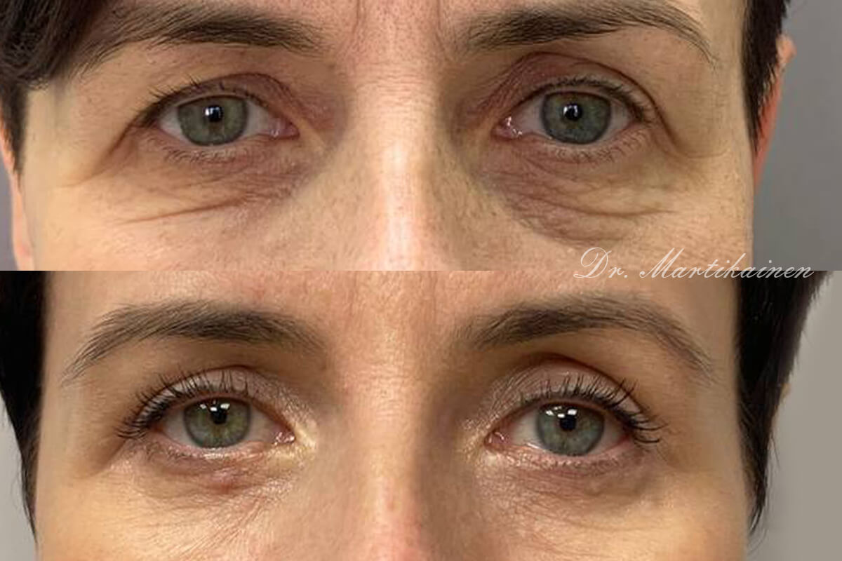 Нижняя блефаропластика 01