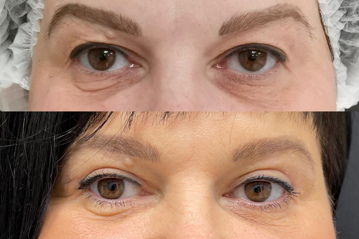 Нижняя блефаропластика 01