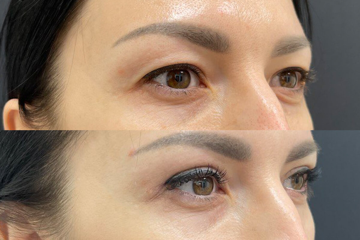 Нижняя блефаропластика 01