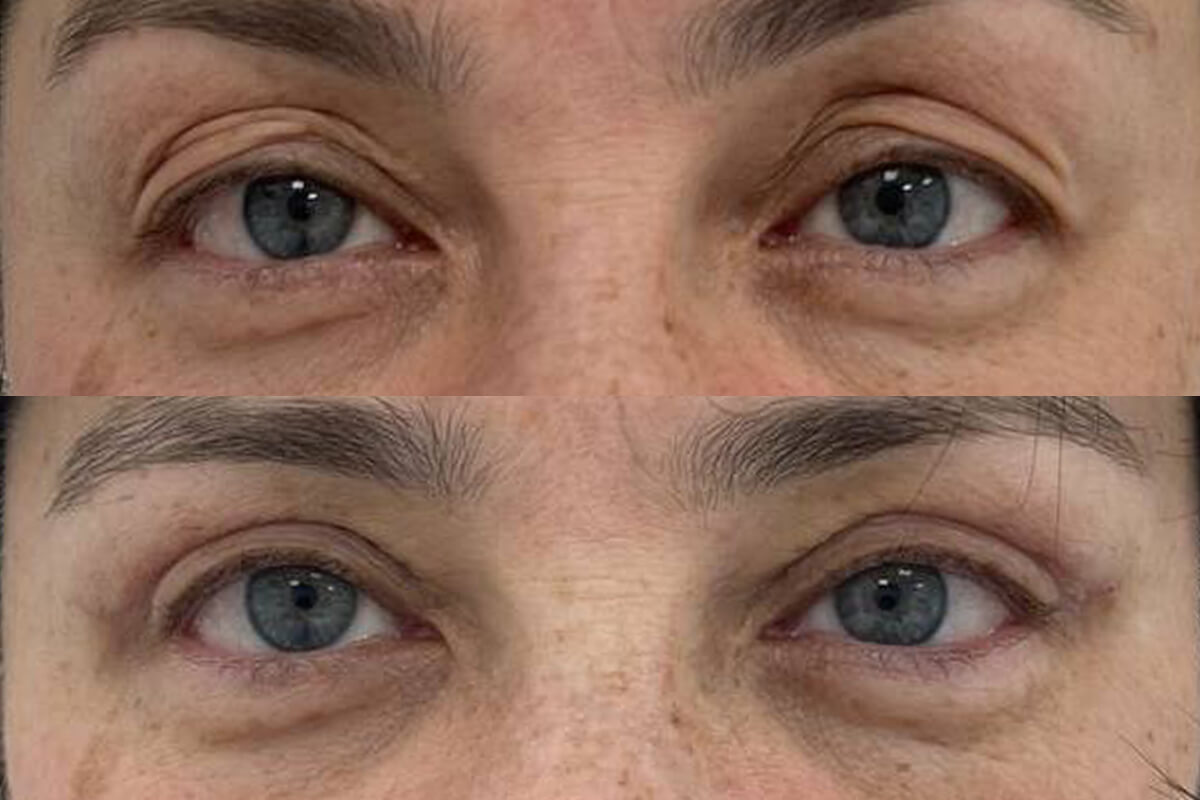 Нижняя блефаропластика 01