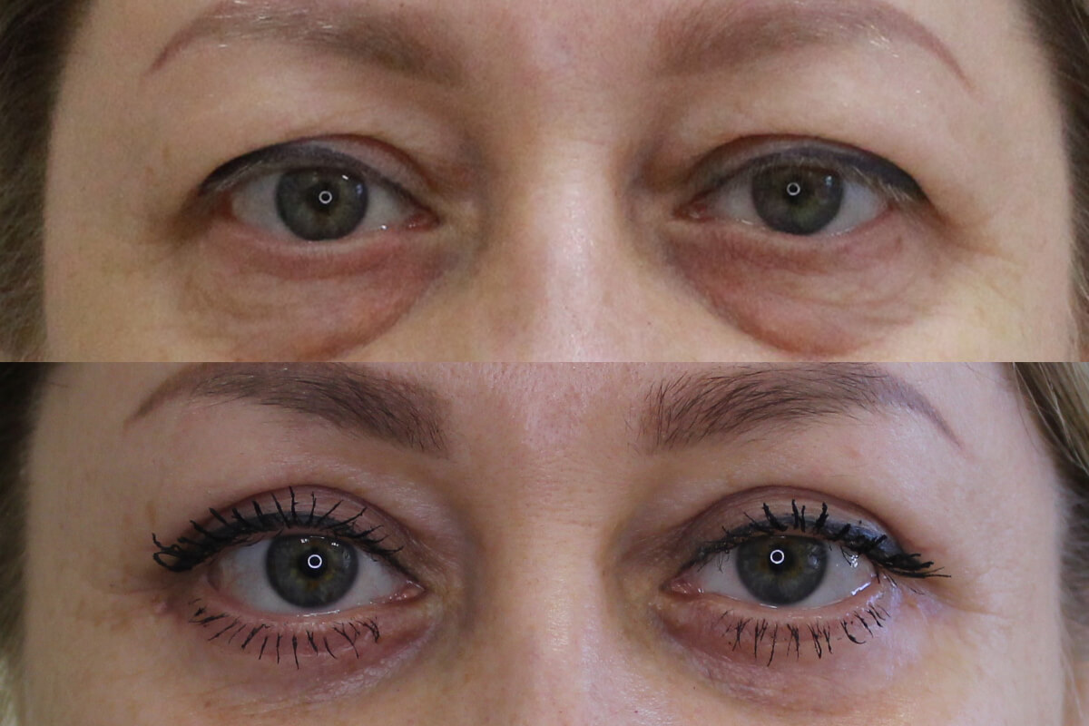 Нижняя блефаропластика 01