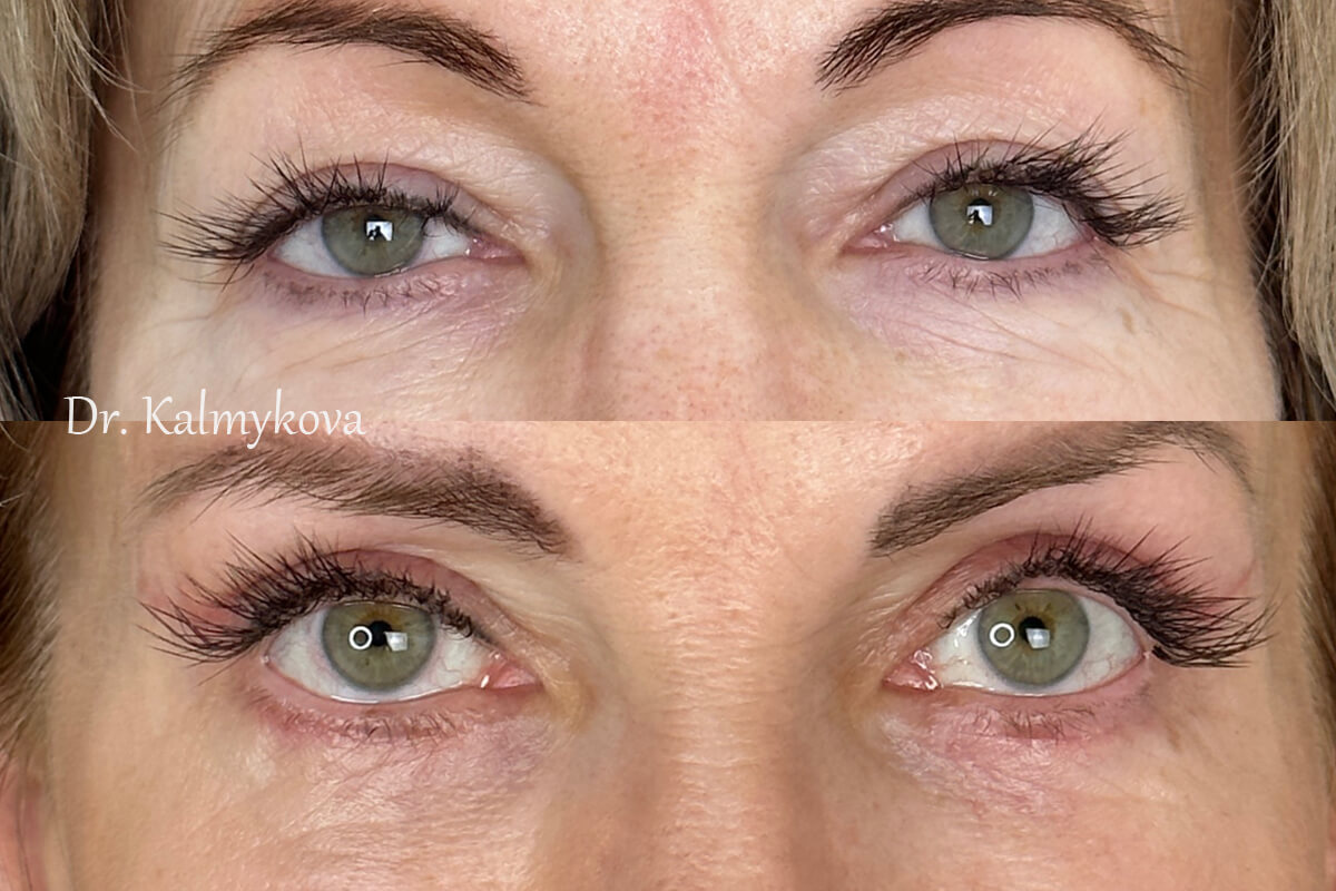 Нижняя блефаропластика 01