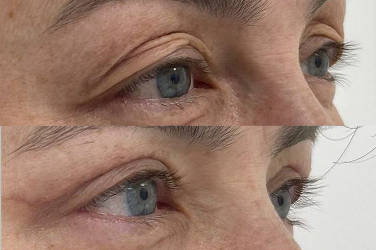 Нижняя блефаропластика 01