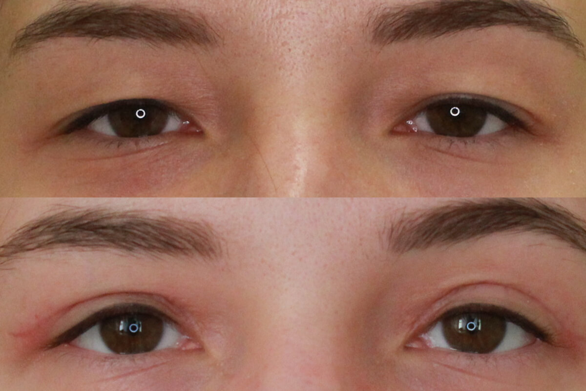 Нижняя блефаропластика 01