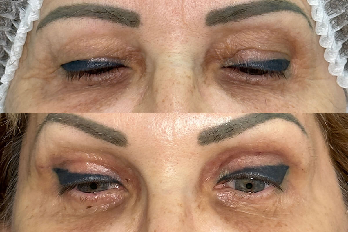 Нижняя блефаропластика 01