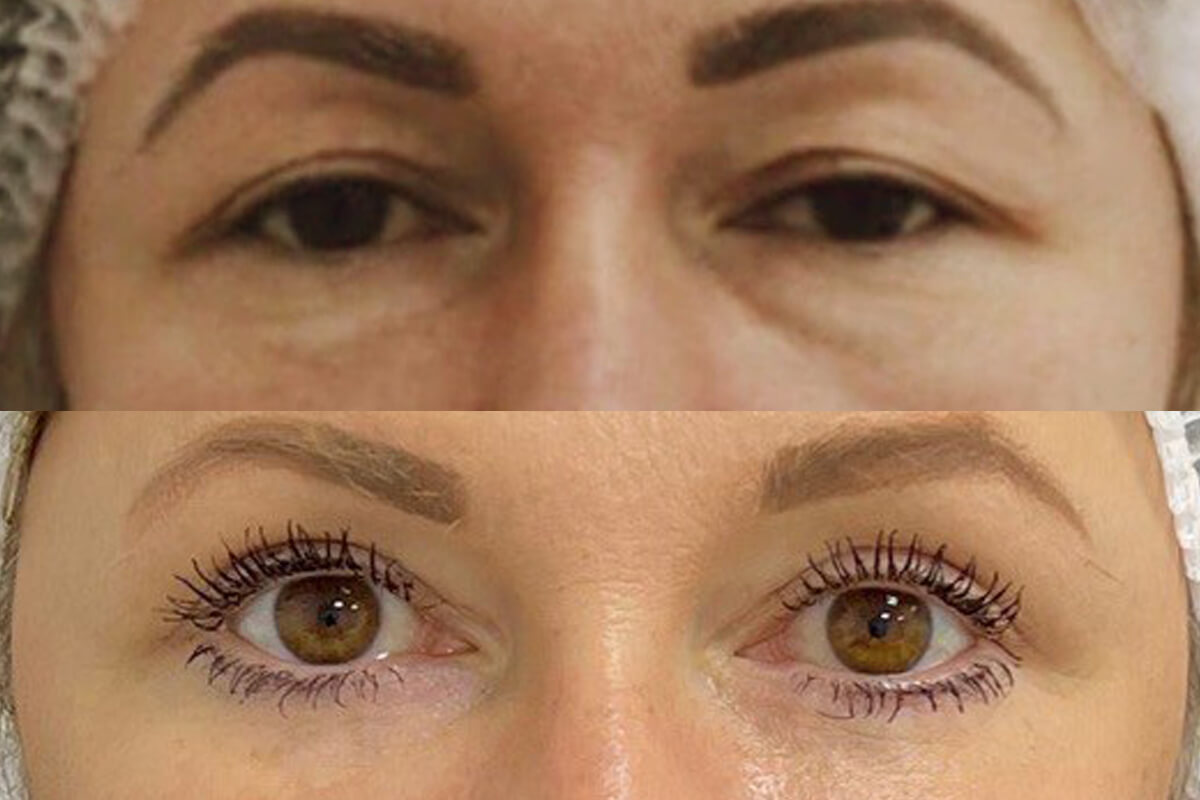 Нижняя блефаропластика 01