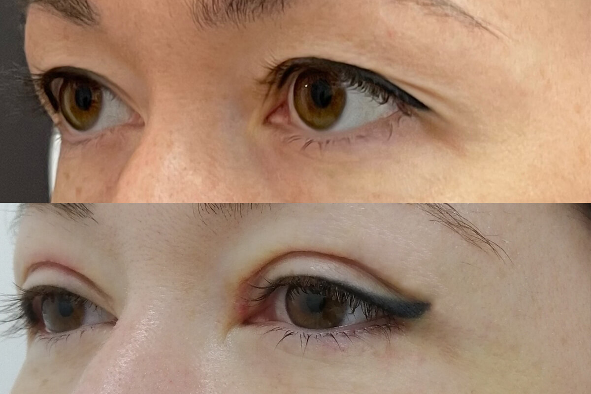 Нижняя блефаропластика 01