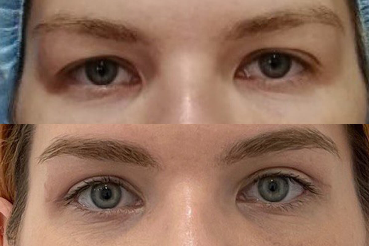 Нижняя блефаропластика 01