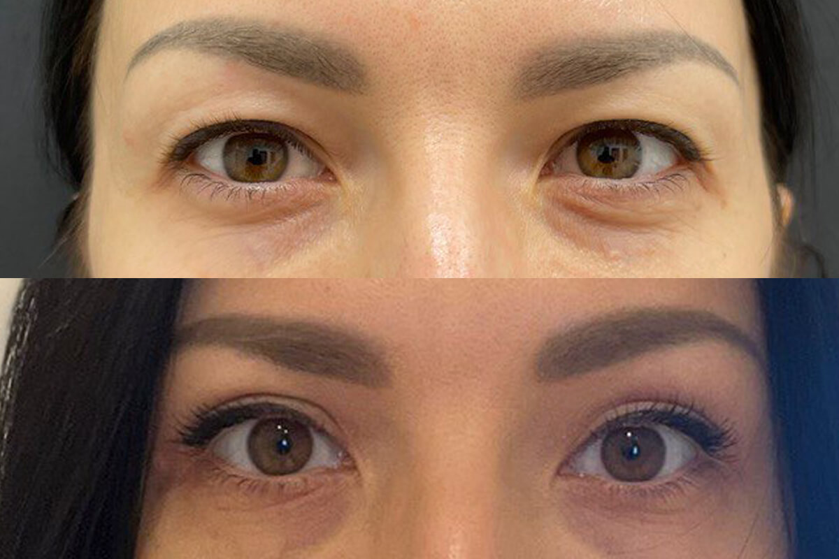 Нижняя блефаропластика 01