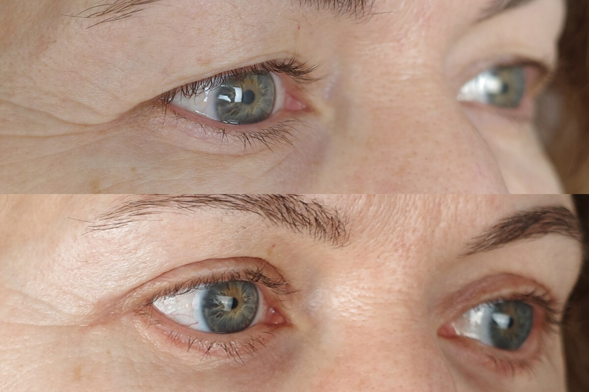 Нижняя блефаропластика 01