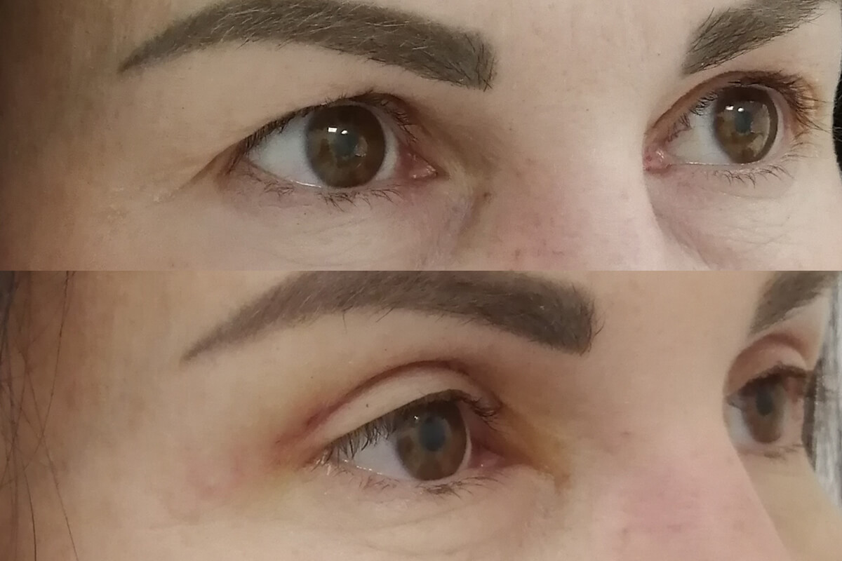 Нижняя блефаропластика 01