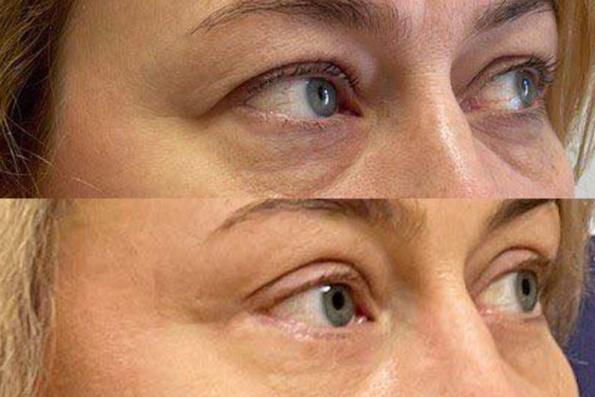 Нижняя блефаропластика 01