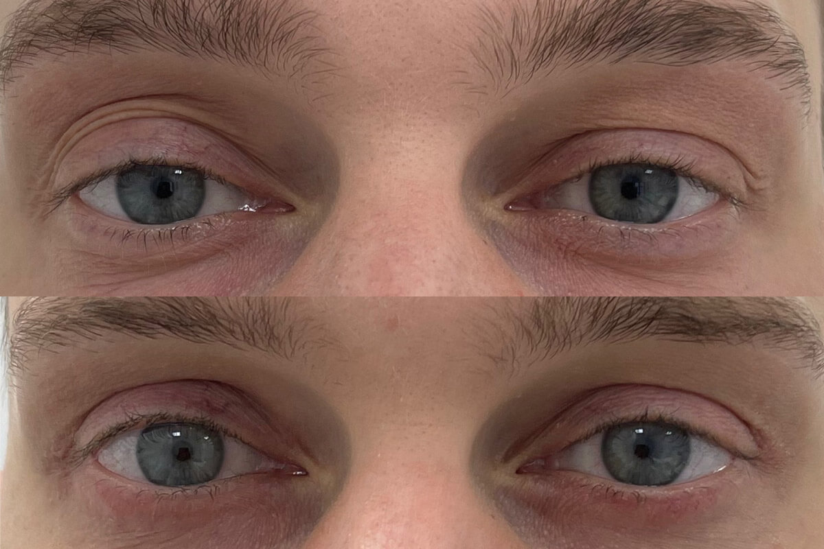 Нижняя блефаропластика 01